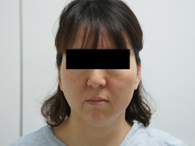 46歳女性　頬・アゴ下ベイザー脂肪吸引と中顔面・ほうれい線脂肪注入