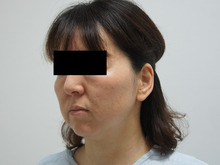 【感想文】46歳女性　頬・アゴ下ベイザー脂肪吸引と中顔面・ほうれい線脂肪注入