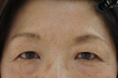 ☆1-2　65歳女性上まぶたのたるみとりを眉下切開でラクに改善2　3か月目まで