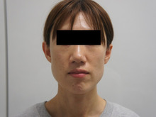 注射だけで別人級の変化（大量10㏄ヒアルロン酸+エラボトックス）