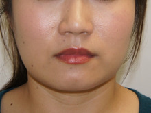 ３０歳女性 小顔BOTOX VISTA（ボトックスビスタ）