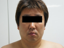 46歳男性　頬・アゴ下のベイザー脂肪吸引ですっきり、若々しく　2　8か月後
