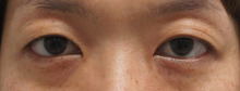 38歳女性　たるみとくぼみが存在するまぶたのセミプレミアムクイック