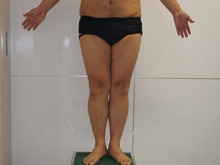 110㎏の男性の大腿・臀部・膝周りベイザー半年後まで　　+全身の変化も