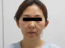 52歳女性　シグネチャーリフト+頬アゴ下ベイザー+脂肪注入で若返り