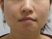 28歳女性　小顔ボトックスビスタ　（えら　BOTOX VISTA）