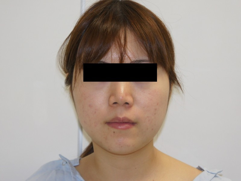 21歳　頬・アゴ下ベイザー脂肪吸引　ダウンタイム軽め