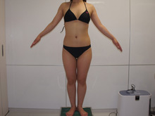 29歳女性　太もも・お尻・膝周りのベイザー脂肪吸引（157㎝53㎏）　1　　3か月まで