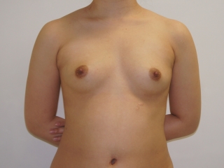24歳女性　皮膚に余裕のないAカップからのCRF豊胸　1　　　　3か月まで