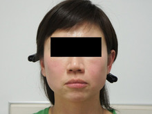 42歳女性　小顔注射後　頬アゴベイザー脂肪吸引（+ほうれい線脂肪注入）にて若返り。