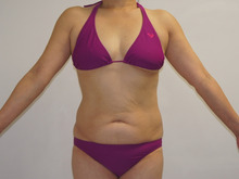 54歳女性　タルミが強い方に対するベイザー脂肪吸引（腹部腰部）　1　　3か月まで