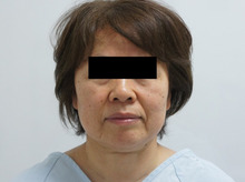 58歳女性　フェイスリフト+頬アゴベイザー+脂肪注入で若々しく　　2　　術後1年まで