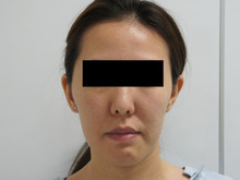 32歳女性　　頬アゴ下ベイザー？　ミントリフト？　・・・ベイザーで若返りを