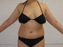 38歳　165㎝73㎏　ベイザー脂肪吸引　半年後まで