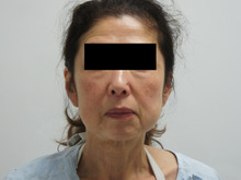55歳女性　シグネチャーリフト+頬・アゴ下ベイザー+中顔面・ほうれい線・アゴ脂注