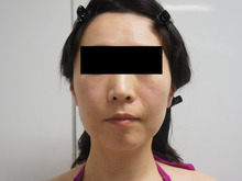 【小顔と若返り】40歳女性　頬アゴ下ベイザー脂肪吸引と中顔面・ほうれい線脂注