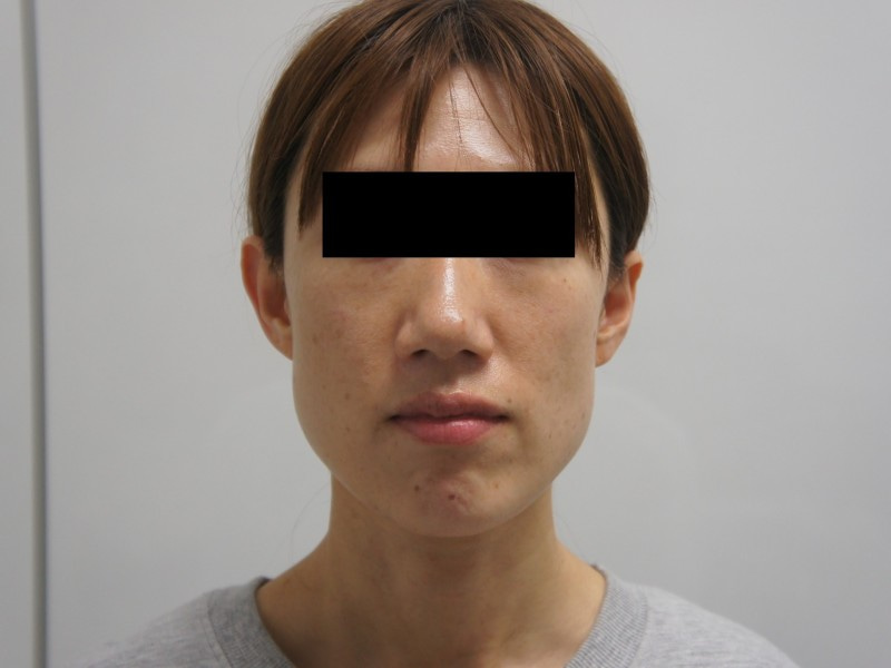 【注射だけで別人級】　幸運を呼び寄せそうな若々しい、美しい顔を得るには