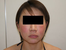 42歳女性　小顔注射後　頬アゴベイザー脂肪吸引（+ほうれい線脂肪注入）にて若返り　2