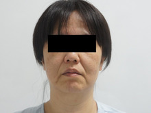 【術後1年3か月】48歳女性　シグネチャーリフト+頬・アゴ下ベイザー+（中顔面+ほうれい線）脂注