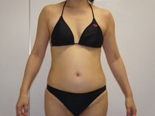 43歳女性　腹部腰部のベイザー脂肪吸引