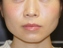 まさに大正解の小顔注射　BOTOX VISTA