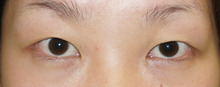他院の切開式眼瞼下垂手術でふたえになれなかった患者様に正しく切開式二重手術