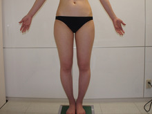 胸郭及びバストボリュームの左右差が大きい患者様のCRF豊胸　　2　　　　　大腿臀部膝VASER