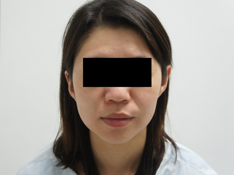 28歳女性153㎝41㎏　　　頬・アゴ下ベイザー脂肪吸引