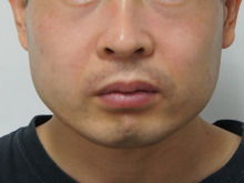 効果超抜群　男の小顔注射