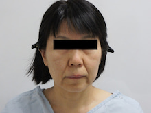 53歳女性　これが本物のフェイスリフトの効果