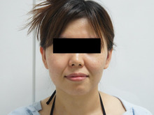 35歳女性　頬・アゴ下ベイザー脂肪吸引+中顔面・ほうれい線・おとがい脂注で美人+若返り