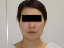 28歳女性　頬・アゴ下ベイザー脂肪吸引+中顔面・ほうれい線・オトガイ脂肪注入