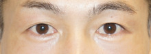 【男性症例】蒙古ひだが少ないけれど左右差の大きい患者様の末広型