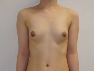 バストに皮膚の余裕がない21歳女性のCRF豊胸（大腿臀部膝ベイザー）1