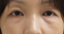 【術後2年半】46歳女性　眼のクマの治療（経結膜脱脂+眼窩脂肪注入）長期経過