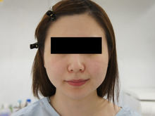 23歳女性　頬アゴ下ベイザー脂肪吸引+ほうれい線・オトガイ脂肪注入