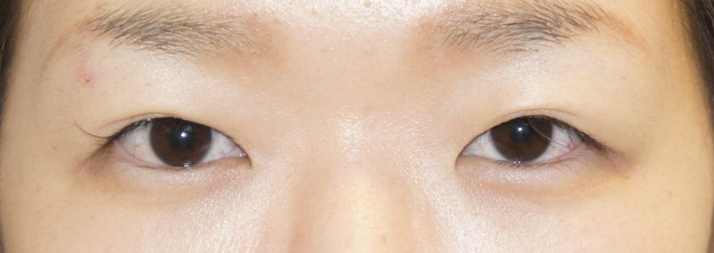 蒙古ひだ強め、皮膚厚め、脂肪多い　条件の悪いまぶたの準平行型（セミプレ・マイクロカット）
