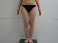 バストに皮膚の余裕がない21歳女性のCRF豊胸（大腿臀部膝ベイザー）2　吸引部