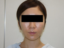 変化控えめ　元来あまり脂肪がついていない方の頬アゴ下ベイザー