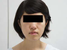 細面の女性をさらに美しくする頬・アゴベイザー脂肪吸引+中顔面脂肪注入【半年まで】