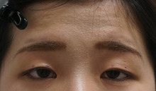 狭い奥ぶたえ+軽度眼瞼下垂　　眉毛を挙げて苦しそうなタイプのセミプレミアムクイック