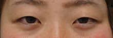 左目だけ眼瞼下垂の一重から二重瞼へ。