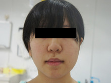 これがベイザー“頬アゴ下脂肪吸引”の劇的な効果　21歳女性155㎝51㎏
