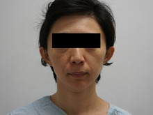 42歳女性　ミントリフトと中顔面ヒアルロン酸で怒涛の若返りо(ж＞▽＜)ｙ ☆
