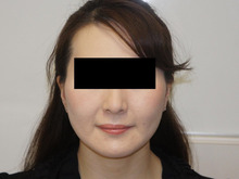 36歳女性　頬アゴベイザー脂肪吸引　少なめ変化でもご本人の満足度　高（直筆感想文）