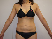 42歳女性160㎝58㎏　出産と体重と加齢で凹凸→若々しい魅力的なおなかへ