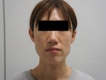 【注射だけで別人級　1年後】　幸運を呼び寄せそうな若々しい、美しい顔を得るには