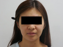 24歳女性　　幼顔から大人女性に　ベイザー頬アゴ下脂肪吸引