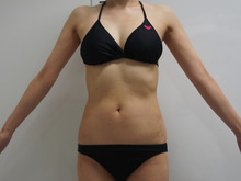 42歳女性　160㎝45㎏　腹部腰部のベイザー脂肪吸引