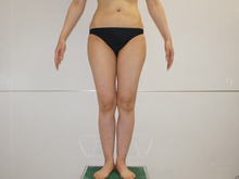 43歳女性165㎝53㎏　大腿臀部膝周りベイザー脂肪吸引